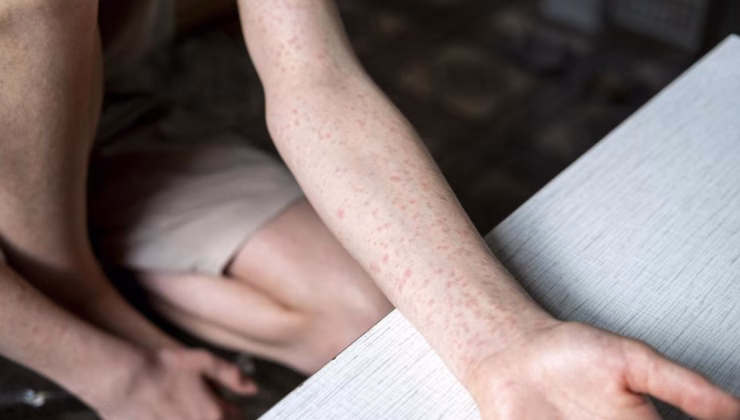 ABD’de bir kızamık alarmı daha!