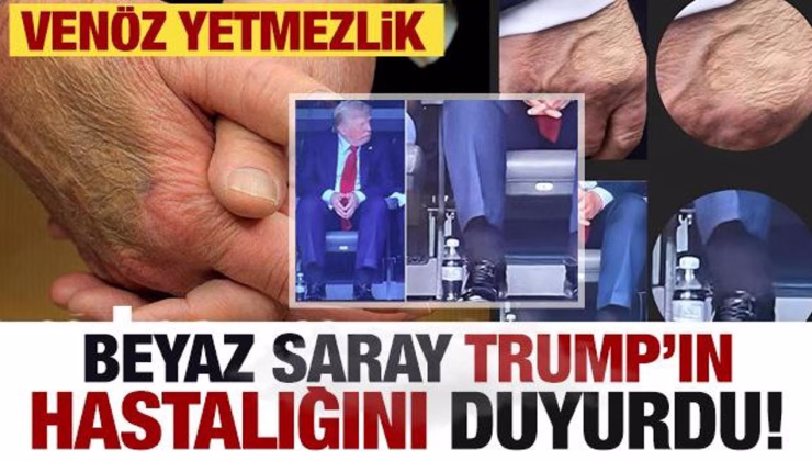 Beyaz Saray Trump’ın hastalığını açıkladı: Venöz yetmezlik